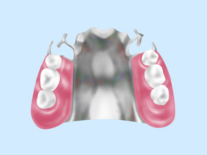 金属床義歯