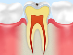 【CO】初期の虫歯