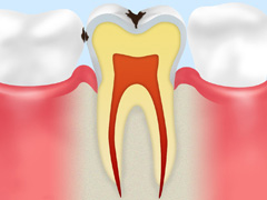 【C1】エナメル質の虫歯