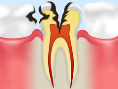 【C3】神経に達した虫歯