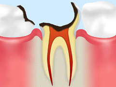 【C4】歯根だけになった虫歯