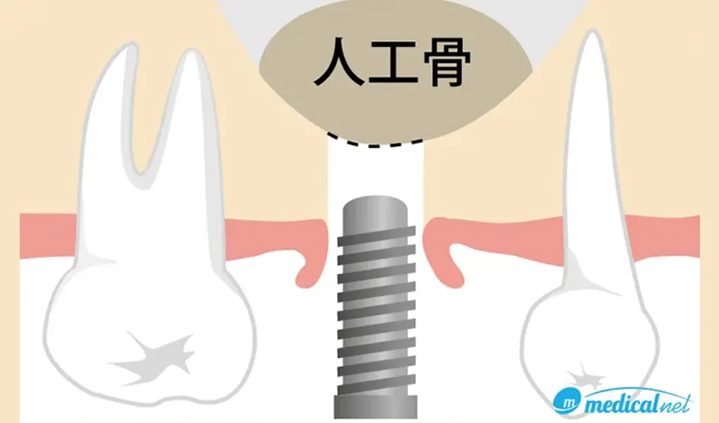 ソケットリフト