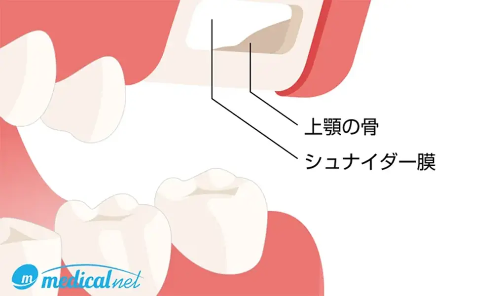 サイナスリフト