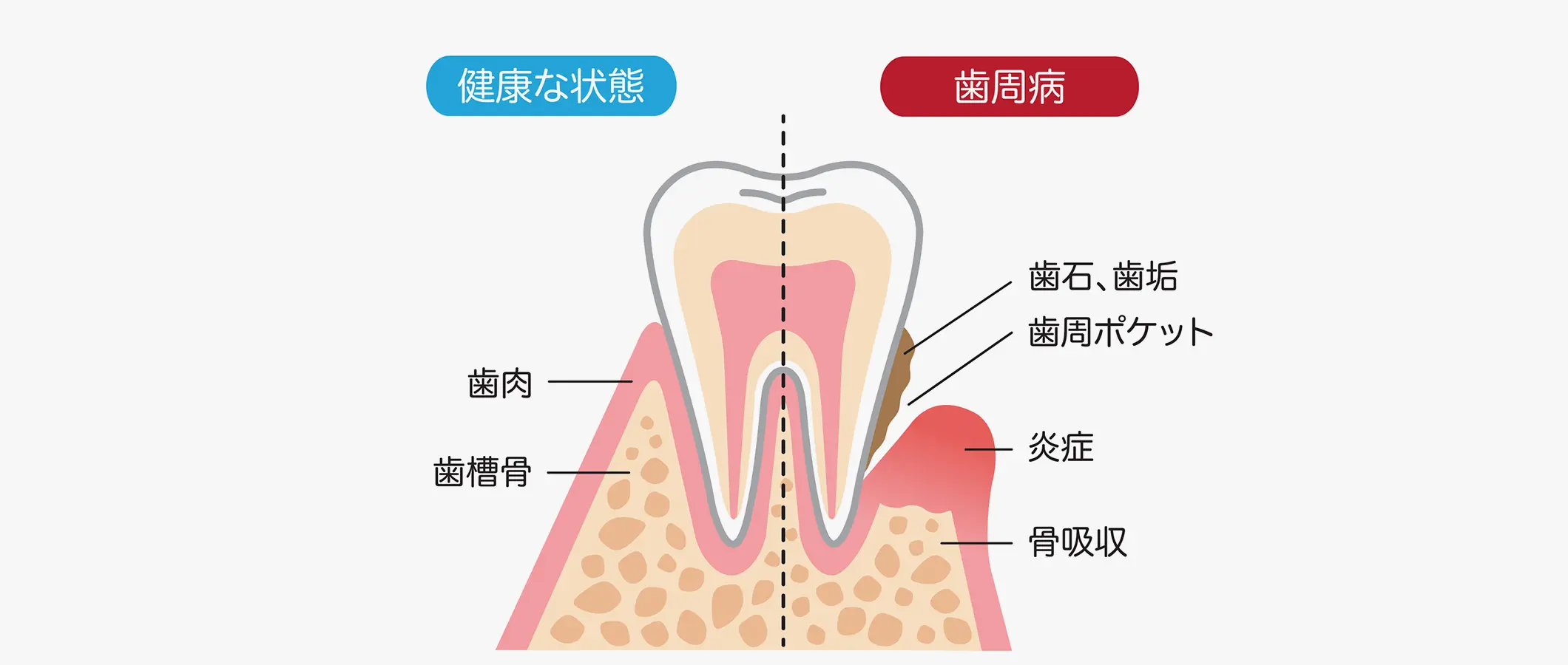 歯周病とは